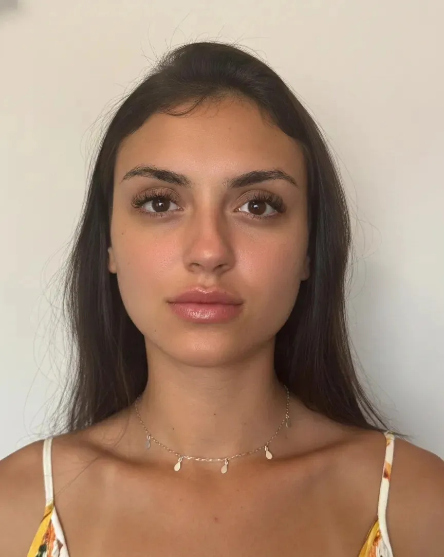 Depois - Harmonização Facial